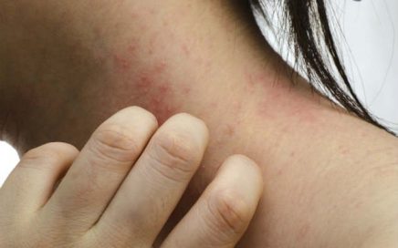 Você conhece a Dermatite de contato? imgHandler 436x272 - Você conhece a Dermatite de contato?