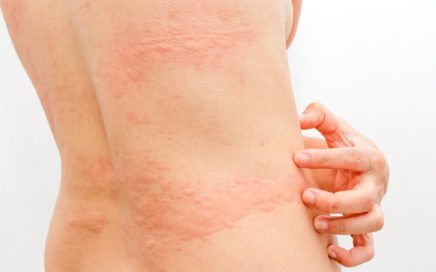 URTICÁRIA – ORIENTAÇÕES tratamento urticaria 436x272 - URTICÁRIA – ORIENTAÇÕES