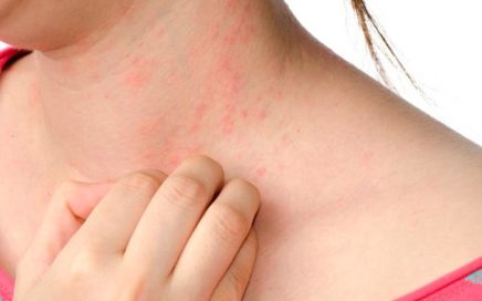 O que é urticaria? urticaria 436x272 - O que é urticaria?